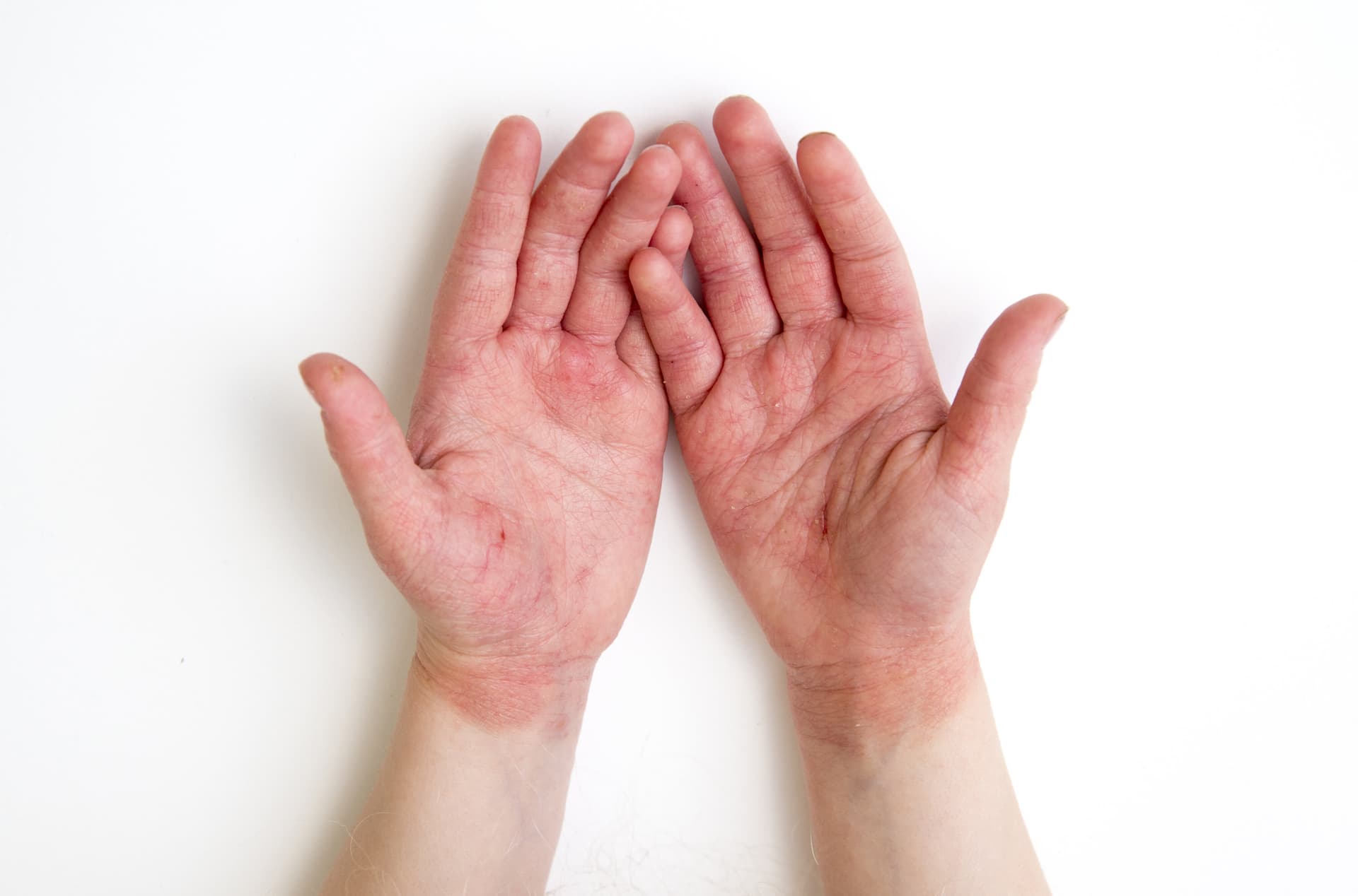 Berufsdermatologie